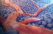 Cancer du rein : angiogenèse et immunité, une combinaison gagnante