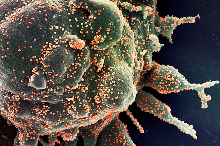 Cellule mourante (en vert) fortement infectée par des particules du nouveau Coronavirus SARS-CoV-2 (en orange) responsable de la Covid-19, en microscopie électronique