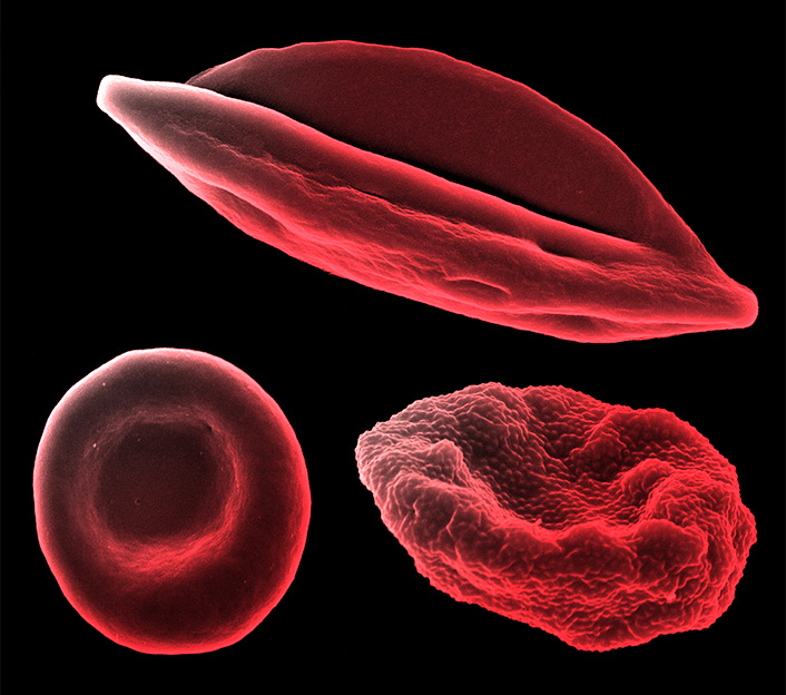 Globule rouge humain sain (en bas à gauche) et globules rouges infectés par Plasmodium falciparum, à différents stades de la maladie (à droite)