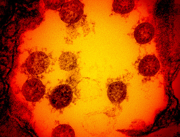 Particules virales de SARS-CoV-2, en microscopie électronique