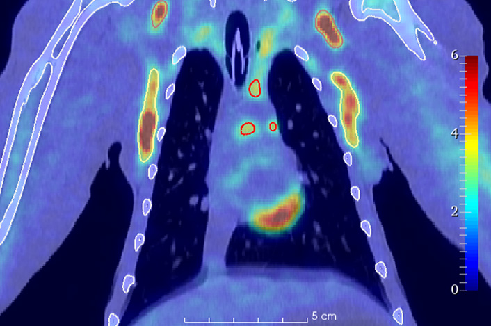 Observation avec l'imageur TEP scan d'IDMIT des modifications d'activité métabolique pouvant indiquer une inflammation, comme ici au niveau de ganglions.