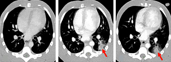 La Covid-19 cause des lésions pulmonaires (flèches rouges) visibles en imagerie TEP scan : avant infection (à gauche), 2 jours après infection (au milieu) et 5 jours après infection (à droite).