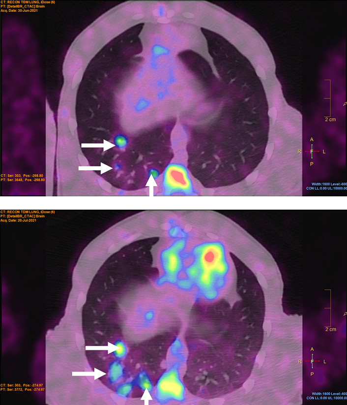 Évolution des granulomes pulmonaires caractéristiques de la tuberculose (flèches), à des temps précoces après infection grâce à l'imageur TEP scan. Les premières lésions sont visibles à 4 semaines post-infection (en haut), et grandissent à 7 semaines (en bas).